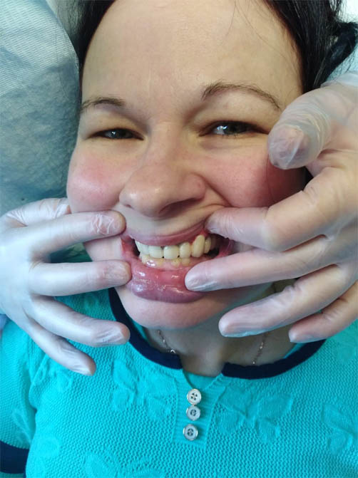 после протезирования зубов 